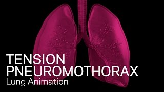 Tension Pneumothorax  Medical Animation [upl. by Eldon436]