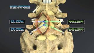 Medical Animation of Lumbar Stenosis Decompression [upl. by Chladek]