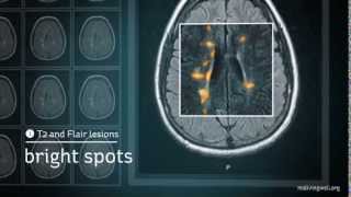 Multiple Sclerosis Understanding Your MRI [upl. by Honor]