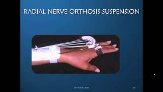 Radial Nerve Rehabilitation amp Orthotic Intervention Preview [upl. by Maurey]