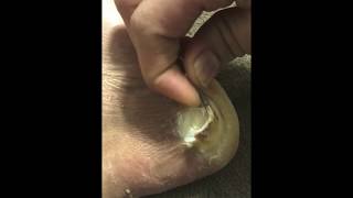 Plantar Wart removal With DuckTape and CompoundW [upl. by Smart]