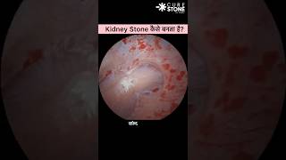 किडनी स्टोन कैसे बनता है  Kidney stone treatment  RIRS  Retrograde Intrarenal Surgery shorts [upl. by Laicram371]