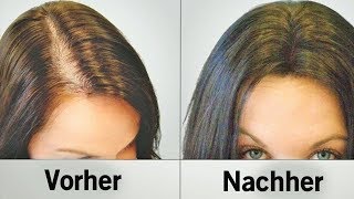 Diese natürlichen Hilfsmittel stoppen Haarausfall und lassen die Haare schneller wachsen [upl. by Kanal]