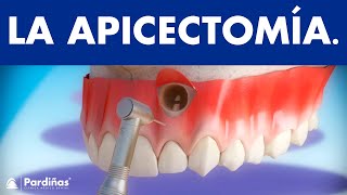 Apicectomía  Tratamiento infección de la raíz del diente © [upl. by Hoj121]