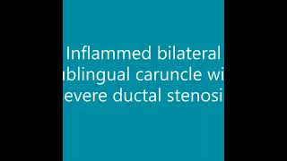 Inflamed Sublingual Caruncle with severe Ductal Stenosis  Dr Nyer Firdoose [upl. by Westphal]