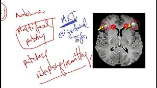 Video 217 Overview of Demyelinating Disorders Clinical Features Diagnostics and Risk Factors [upl. by Harwell731]