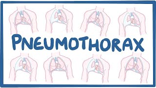 Pneumothorax  causes symptoms diagnosis treatment pathology [upl. by Sofia358]