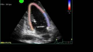 ABNORMAL STRAIN LONGITUDINAL ECHO [upl. by Ythomit]