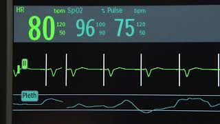 Efficia DFM100 Pacing 77 [upl. by Donough]