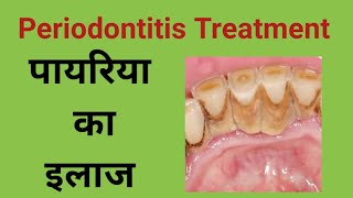 pyorrhea treatmentपायरिया का इलाज कैसे किया जाता हैPeriodontitis treatment pyorrhea medicine [upl. by Nivets]