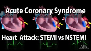 Acute Coronary Syndrome Unstable Angina NSTEMI and STEMI Heart Attack Animation [upl. by Davon]