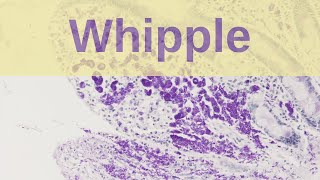 Whipples disease  Pathology mini tutorial [upl. by Odab534]