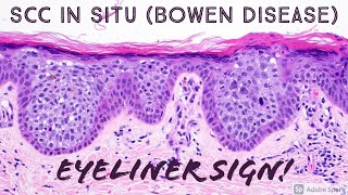 quotEyeliner Signquot best ever in squamous cell carcinoma in situBowen disease dermpath dermatology [upl. by Naicad465]