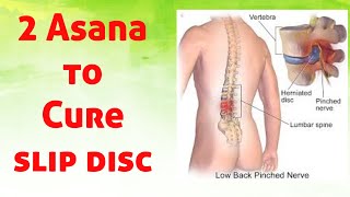 How to Cure Slipped Disc [upl. by Xirdnek]