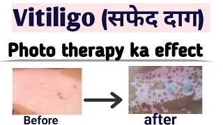 How to treat generalized vitiligo psoriasis with the safest wayUV Phototherapy [upl. by Greenwell]