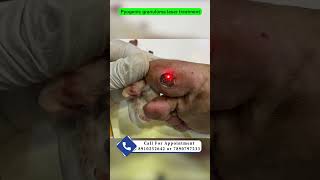 Pyogenic granuloma laser treatment  red bump on sole  pyogenic granuloma का इलाज़ Dr Uttam Lenka [upl. by Eeldarb618]