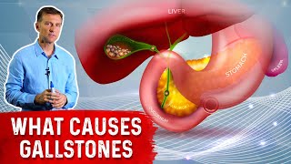 What Really Causes Gallstones  Dr Berg [upl. by Mairim612]