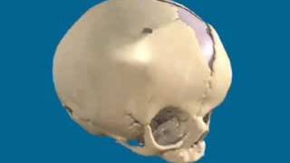 Treatment of Coronal Synostosis  Craniosynostosis Surgery [upl. by Asirralc]