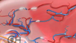 Treatment Options TwinTwin Transfusion Syndrome TTTS 5 of 9 [upl. by Aisaim]