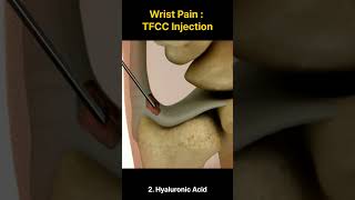 Wrist Pain  TFCC Injections [upl. by Aitnas]