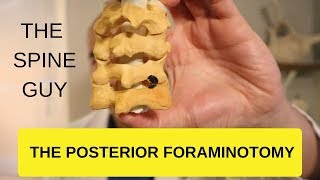 CERVICAL STENOSIS RADICULOPATHY  PART 4  THE POSTERIOR FORAMINOTOMY [upl. by Lladnar]