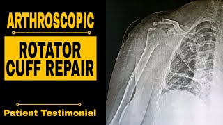 ARTHROSCOPIC ROTATOR CUFF REPAIR [upl. by Laing342]