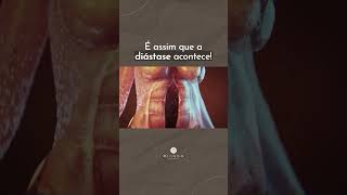 É assim que acontece a diástase abdominal 🫣 [upl. by Leora]