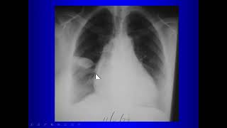 Abnormalities on Thoracic Radiography for Medical Students [upl. by Dyraj]