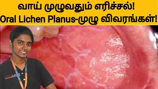 வாய் முழுவதும் எரிச்சல் Lichen Planusமுழு விவரங்கள்Teeth burning sensation causes and treatment [upl. by Vullo]