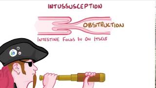 intussusception [upl. by Ejroj481]