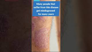 Can Psoriasis cause Arthritis Learn about Psoriatic Arthritis [upl. by Yleoj]