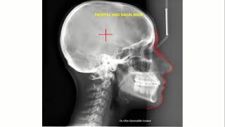 Lateral Cephalometric radiograph tracing Ceph tracing 2 [upl. by Edorej488]