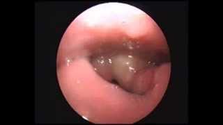 EPiglottitis OPD Scopy AVI [upl. by Barling]