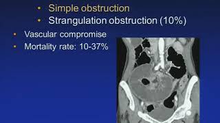 Acute Mesenteric Ischemia MDCT Evaluation Jay Heiken MD SCBTMRSABI 37th Annual Conference [upl. by Boigie]