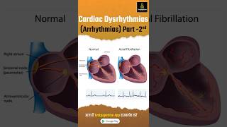 Cardiac Dysrhythmias Arrhythmia Part2  Types of Cardiac Arrhythmia Cardiac Dysrhythmias [upl. by Modern]