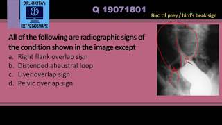 Sigmoid volvulus  Radiology signs [upl. by Antrim]