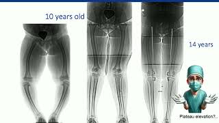 Blount’s Disease•What is important in Blount’s  A Cherkashin [upl. by Pang]