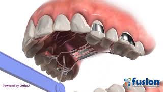 Hyrax palatal expander A form of Rapid Palatal Expansion devices [upl. by Bottali]