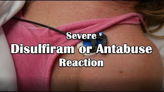 Disulfiram or Antabuse Reaction Emergency [upl. by Annasiul]