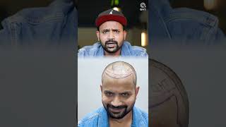 Youtuber Topa Bhai  Nadeem Bunny  Hair Transplant Journey  Before and After Surgery shorts [upl. by Trilbi]