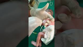 ptnd newborn baby boy wat 19kgnicu [upl. by Lepley454]