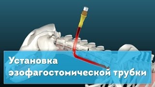 Установка эзофагостомической трубки Esophagostomy Tube Placement [upl. by Pish]