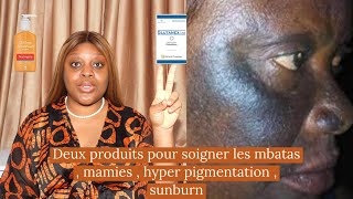 Comment guérir et éviter les brûlures du visage les mbatas  sunburn  mamies  les discolorations [upl. by Acimahs639]