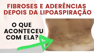 Tratamento para Fibroses e Aderências depois da lipoaspiração entenda o que aconteceu com ela [upl. by Nniuq]