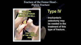 Fractures Of The Femur Head Pipkin Fracture  Everything You Need To Know  Dr Nabil Ebraheim [upl. by Ttevy]