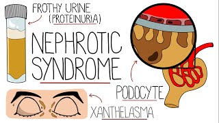 Nephrotic Syndrome Explained Clearly [upl. by Noak28]