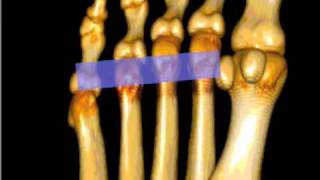 How To Mortons Neuroma Case Study Video [upl. by Yraek]