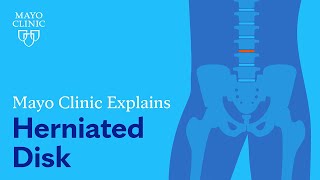 Mayo Clinic Explains Herniated Disk [upl. by Arihsan]