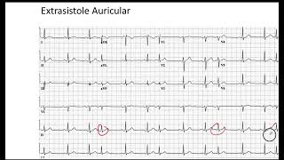 Extrasistole Auricular EKG [upl. by Liw]