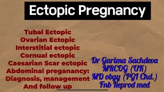 Ectopic pregnancy diagnosis management and follow up plan [upl. by Aitnas]